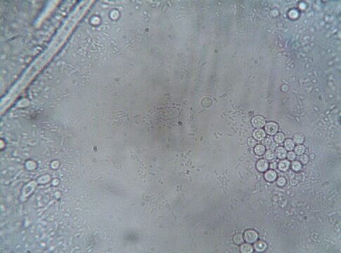 Featured image related to New case of flesh-eating vibrio Vulnificus reported in a child in Clay County, health records